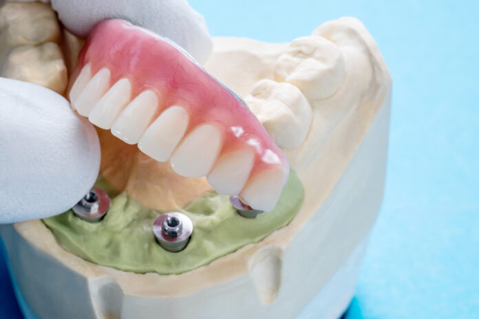 dental implant auckland